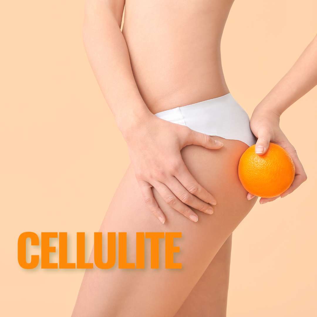 Cellulite: Come Combatterla con i Giusti Prodotti